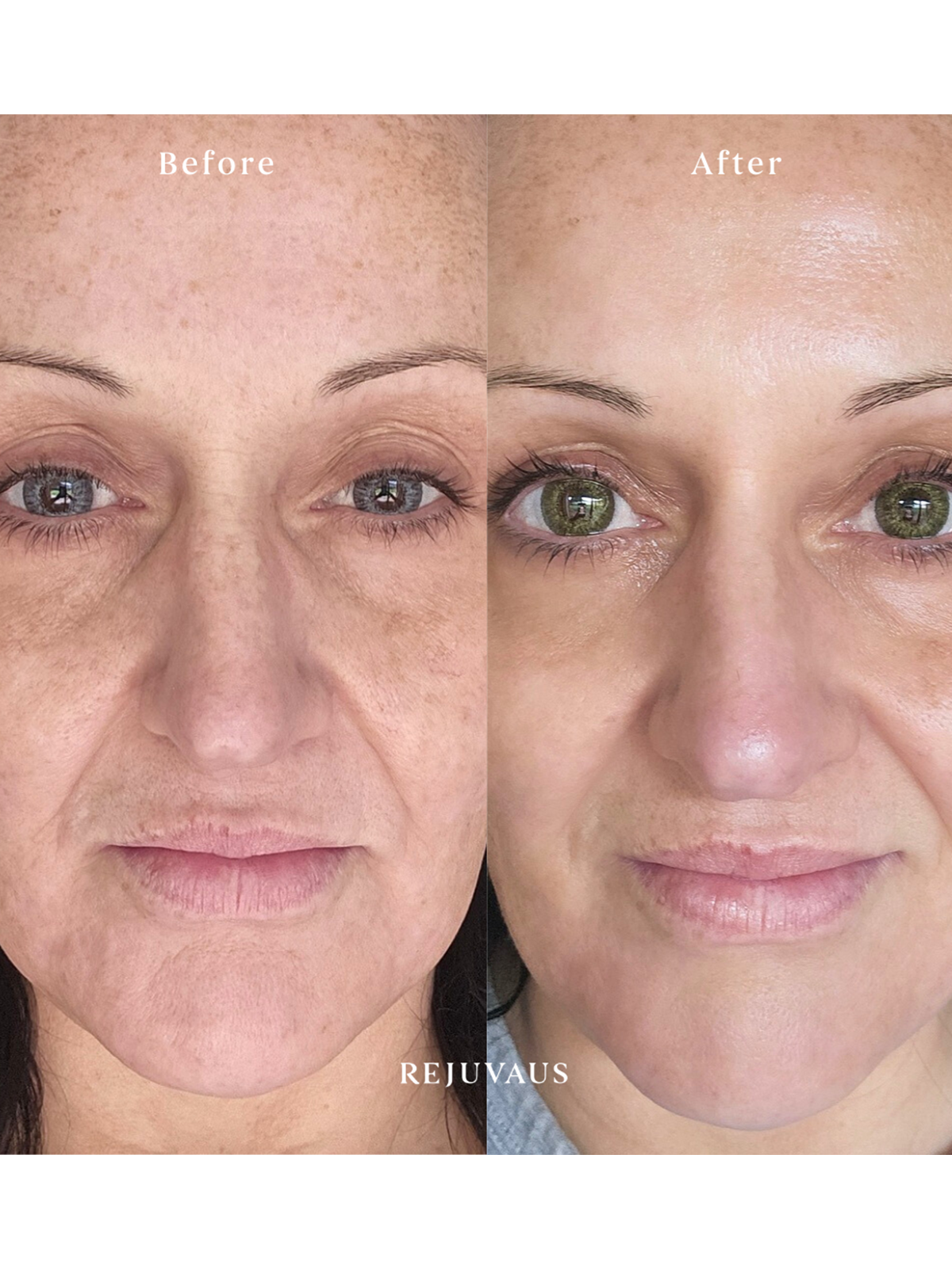 Before & After Retinol and Vitamin C