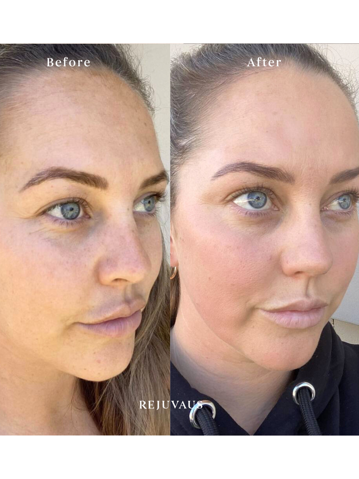 Before & After Salicylic Acid Serum